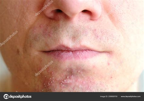 Skin Irritation After Shaving On Mans Skin Closeup Nose And Lips