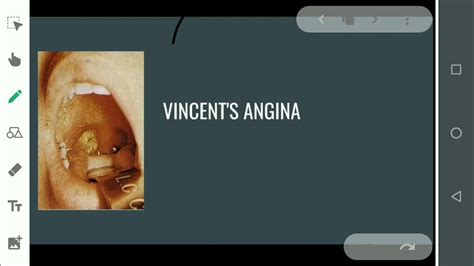 Angina De Plaut Vincent