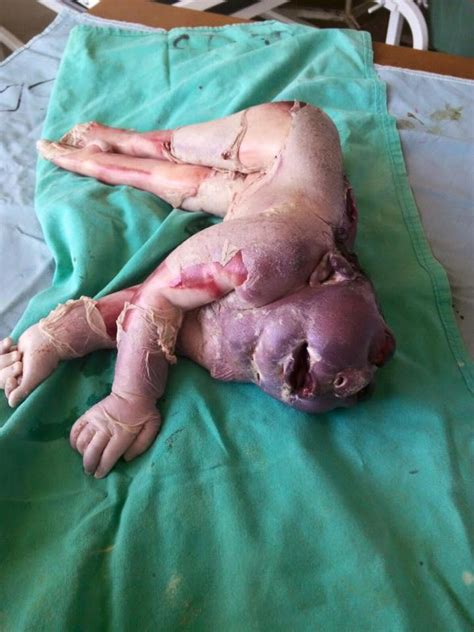【閲覧注意】ジンバブエの女性が産んだ ”赤ちゃん” 、医者もショックを受けるほどの衝撃的なその姿 ポッカキット