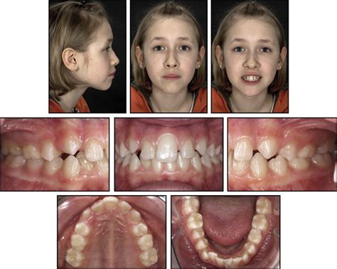 Premolar Transplantation In A Patient With Solitary Median Maxillary