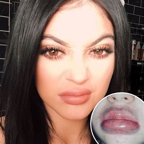 Kylie Jenner Lip Challenge Produces Terrifying Results—teens This Is Not The Way To Plump Your