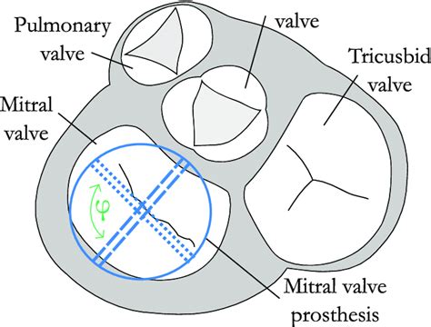Valvular Plane With Schematic Orientation Of The Mechanical Mitral