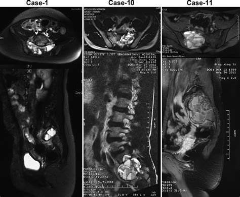 Primary Aneurysmal Bone Cyst Of Sacrum For Adolescent Eleven Cases Experience And Literature