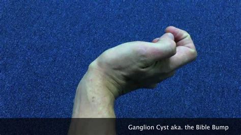 You Decide My Fate Ganglion Cyst Aka The Bible Bump Youtube