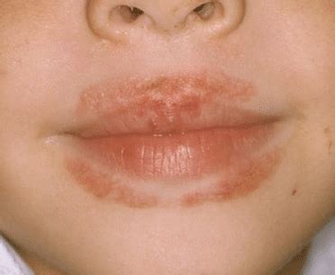 You may get it on your mouth, face and neck. Rash around Mouth, Lips, Itchy, Dry Skin, Nose, Causes ...