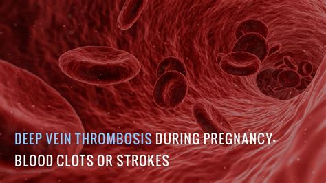 Deep Vein Thrombosis During Pregnancy Blood Clots Or Strokes Youtube