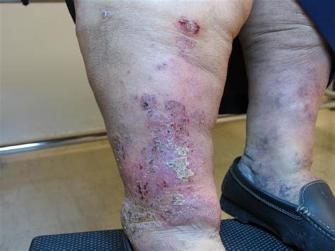 Dermatitis Ekzema Infected Eczema Picture Hellenic Dermatological