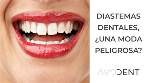 Diastemas ¿cómo Corregir Los Dientes Separados Clínica Dental