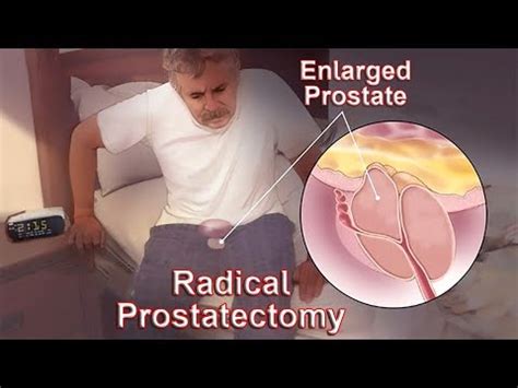 Steps Of Robotic Radical Prostatectomy Surgery By Expert Surgeon Prostate Cancer Surgery