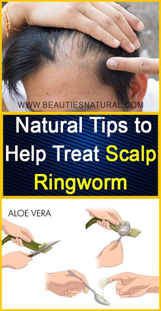 Natural Tips To Help Treat Scalp Ringworm With Images Ringworm