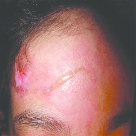 Skin Sloughing On The Right Side Of The Forehead During The Chin