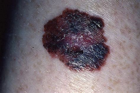Melanoma Pictures 54 Photos And Images