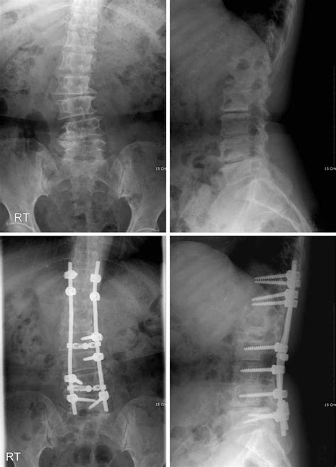 A 62 Year Old Female With Degenerative Scoliosis With Severe Spinal
