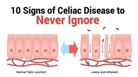 10 signs of celiac disease to never ignore 6 minute read signs of celiac disease celiac