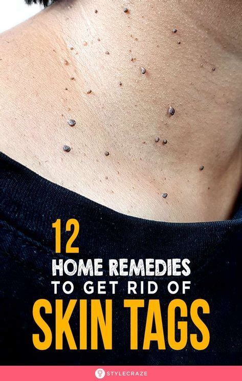 In most cases water and soap will be enough to remove epoxy from skin. 12 Effective Home Remedies To Remove Skin Tags | Remove ...