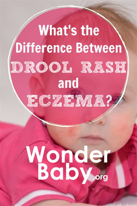 Drool Rash Vs Eczema How To Tell The Difference