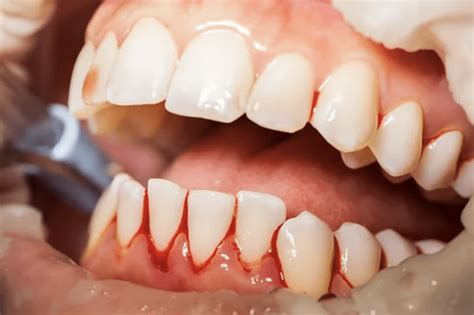 What Causes Bleeding Gums Dentist In Trinity Fl
