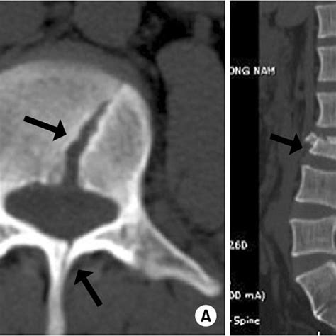 Axial A And Sagittal B Ct Scans Show L3 Burst Fracture With