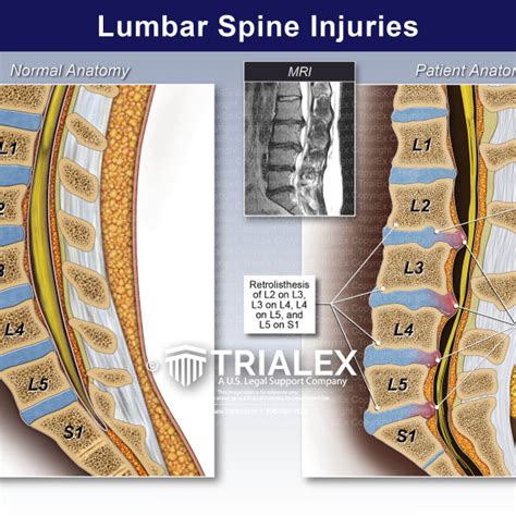Lumbar Spine Injuries Trialexhibits Inc