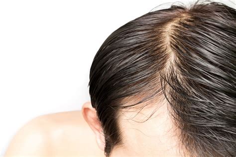 4 Natural Home Remedies To Treat Oilygreasy Hair News By Nature