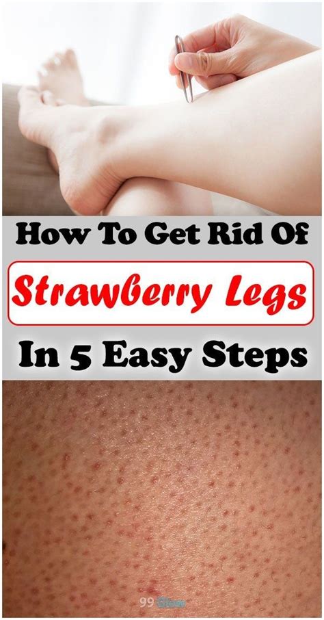 How To Get Rid Of Strawberry Legs In Easy Steps Strawberry Legs