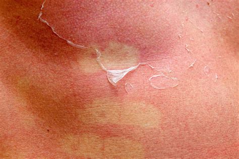 250 Sunburned Human Skin Peeled Peeling Stock Photos Pictures