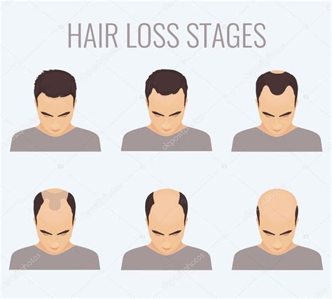 Male Pattern Baldness Stages — Stock Vector © Naumas 114144136
