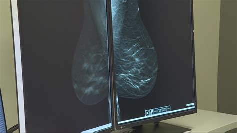Artificial Intelligence In Breast Cancer Screening