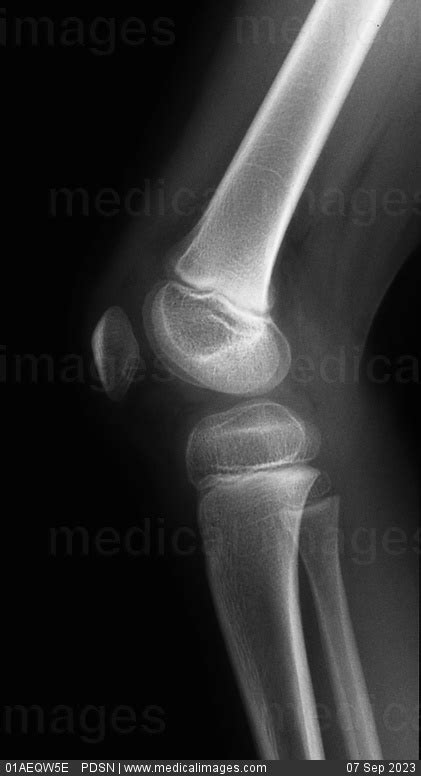 Stock Image X Ray Of The Normal Knee Joint Side View In A 7 Year Old