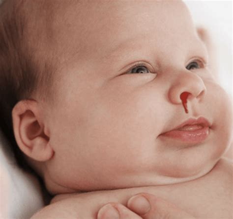 Newborn Care Nose Philadelphia Fight