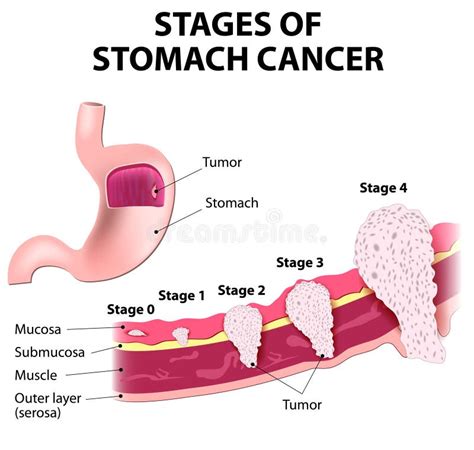 Staging Of Stomach Cancer Stock Vector Illustration Of Body 46011976