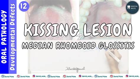 Median Rhomboid Glossitis Kissing Lesion Central Papillary Atrophy