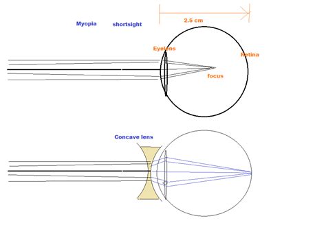 Lenses Correct Vision By Brainly List Two Causes Of Presbyopia Draw
