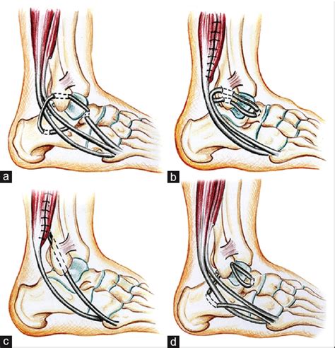 Sports Injury Bulletin Anatomy Masterclass On Ankle Injury Part Ii