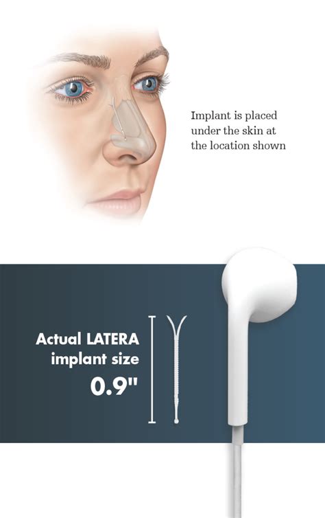Nasal Valve Collapse Accent Head And Neck Group