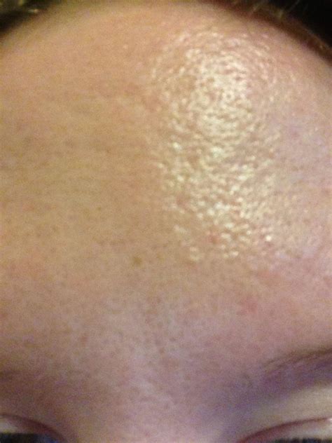 Topical Treatments For Skin Texture And Large Pores Scar Treatments
