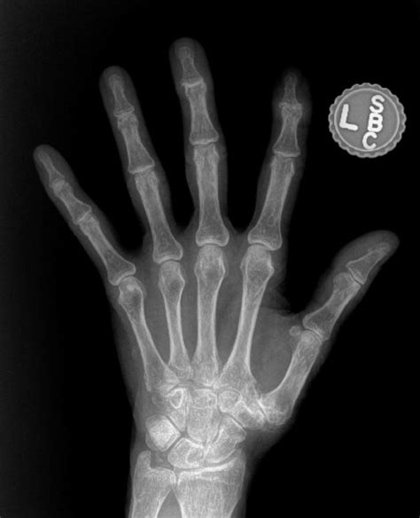 What Does Hand Arthritis Look Like On X Ray John Erickson Md