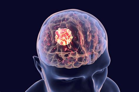 12 Warning Signs Of Brain Tumors You Should Not Ignore