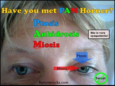 Horner Syndrome Medical Intuitive Medical Mnemonics Emergency Medicine