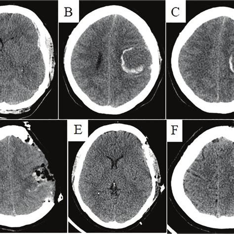 Preoperative Noncontrast Computerized Tomography Ct Scan Of The Brain