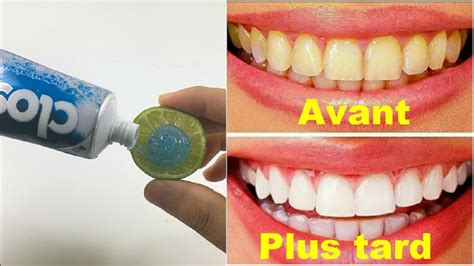 Comment Blanchir Les Dents En 2 Minutes Dents Blanches Et Brillantes