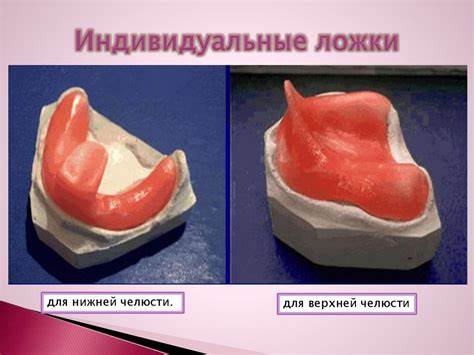Индивидуальные ложки - презентация онлайн Картинка - Индивидуальные ложки - презентация онлайн