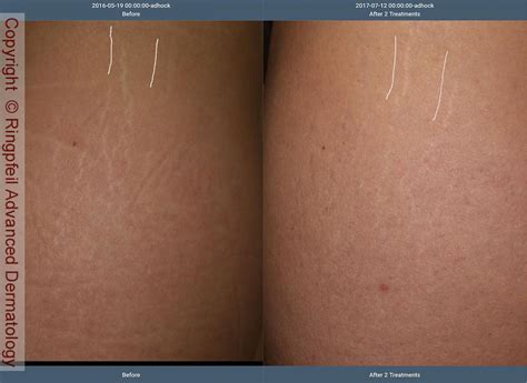 Vorläufer sich verhalten Person stretch marks before and after laser