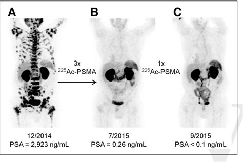 Psma 617 structure (page 1). Figure 1 from 225 Ac-PSMA-617 for PSMA-Targeted a ...