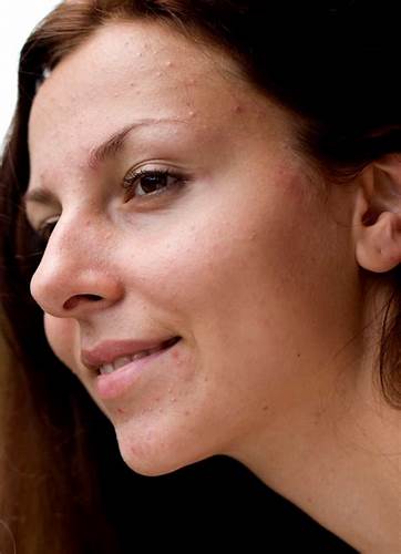 Диатез диета меню Диатез у взрослых Диатез у взрослых Диатез диета меню