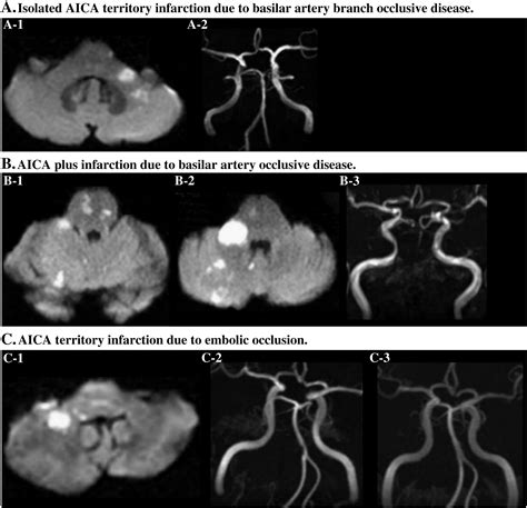 Audiovestibular Loss In Anterior Inferior Cerebellar Artery Territory