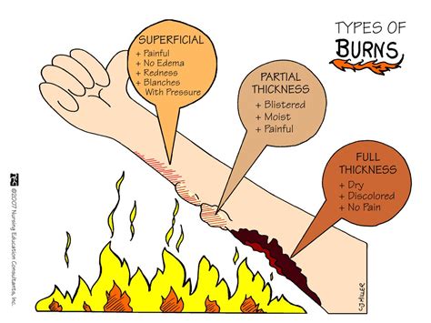 Difference Between 1st 2nd And 3rd Degree Burns