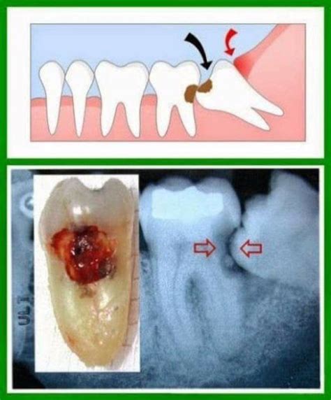 Wisdom Teeth Impaction Dentist Endeavour Hills Totally Teeth