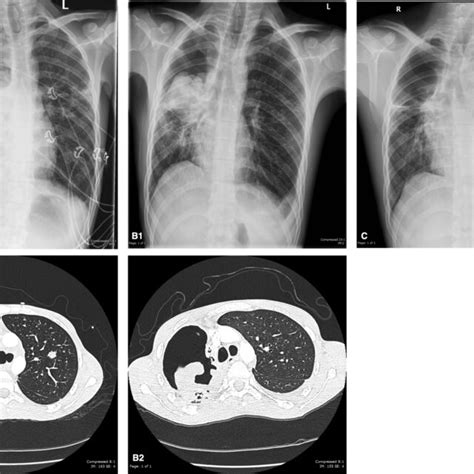 A1 A2 Chest X‐ray Cxr And Computed Tomography Ct Chest Showing A
