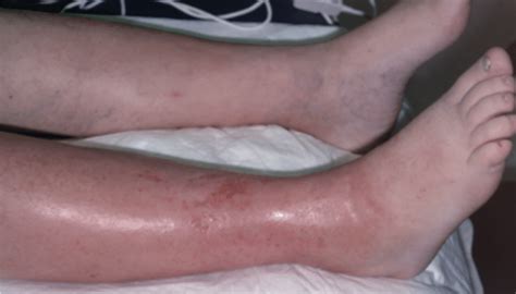 Getting Under The Skin Approach To Antibiotic Selection For Cellulitis